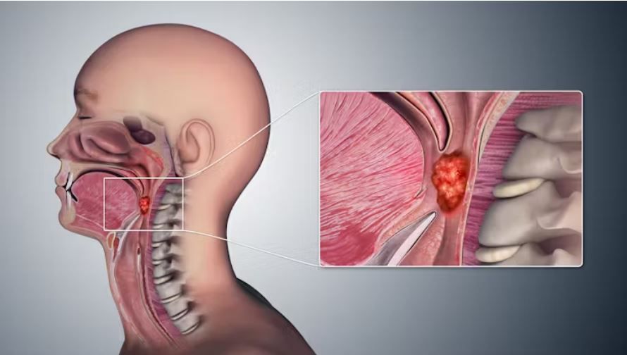 Here are 10 signs and symptoms of throat cancer you should know